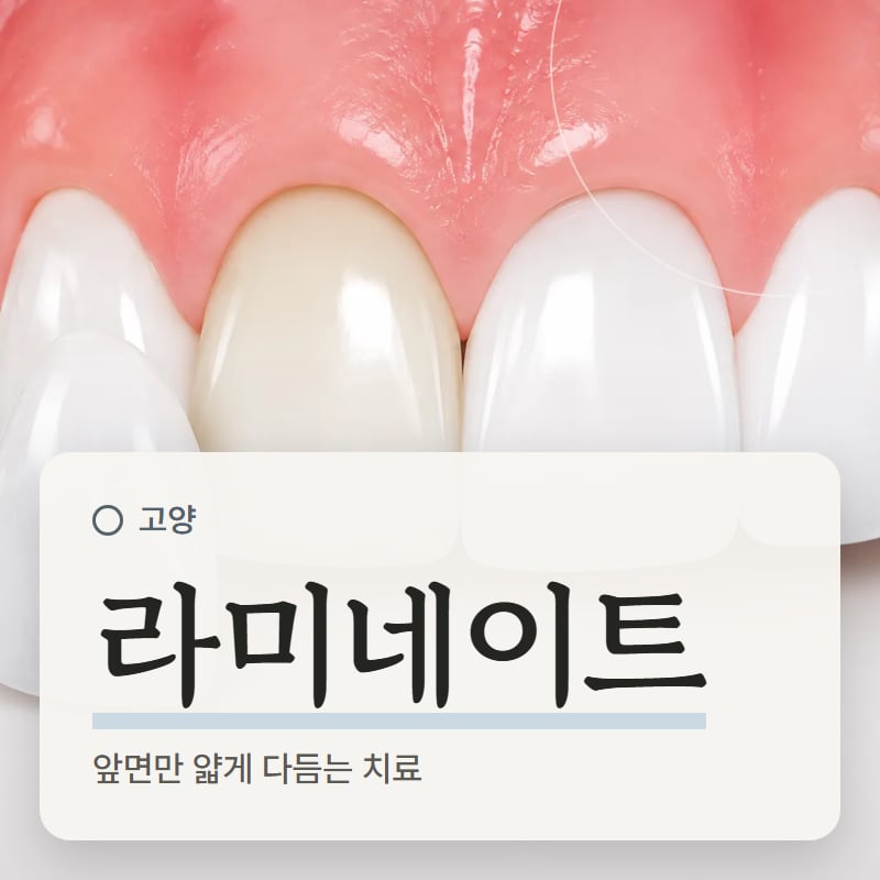 앞니 앞에 얇은 세라믹 라미네이트를 대어 보는 모형