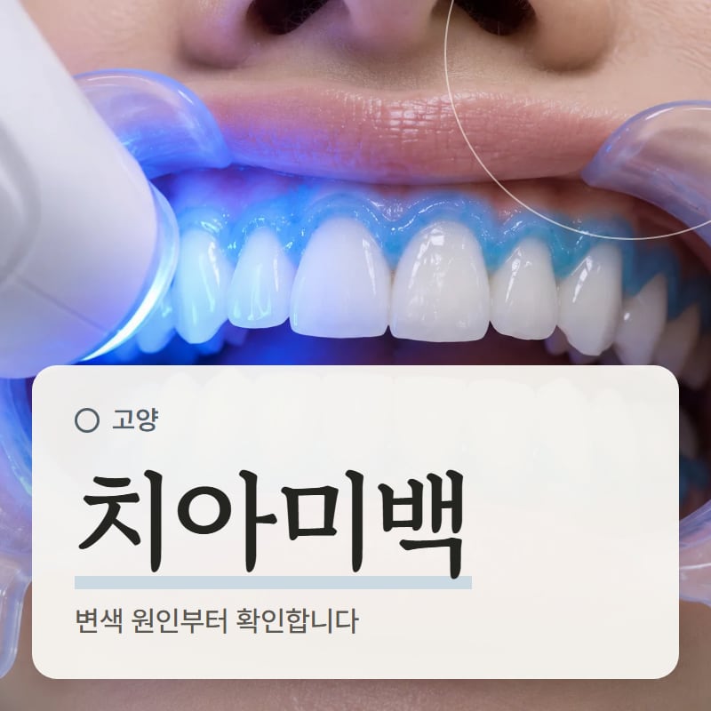 미백 약제를 바른 앞니에 빛을 비추는 모습